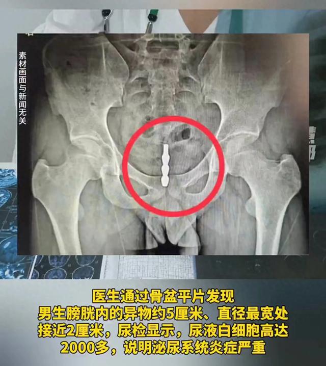 福建一大学生将螺旋状钢管塞进尿道不料异物一路“溜”进膀胱(图1)